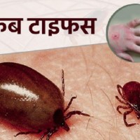 २२ जनामा स्क्रब टाइफसको सङ्क्रमण