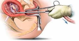 Unsafe abortion continues to be challenge to safe motherhood and reproductive health